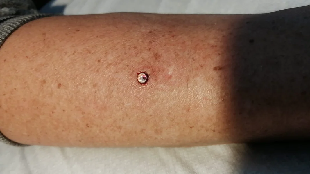 microdermal avanbraccio