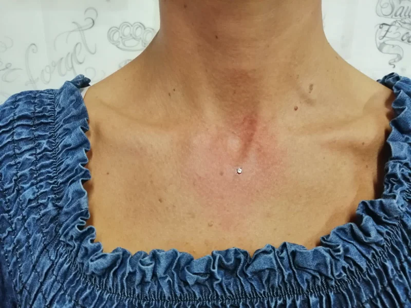 microdermal gola