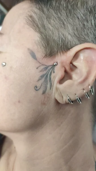 microdermal preauricolare