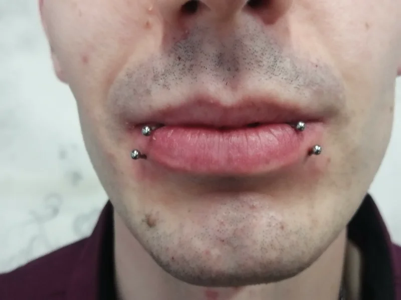 snake bite
