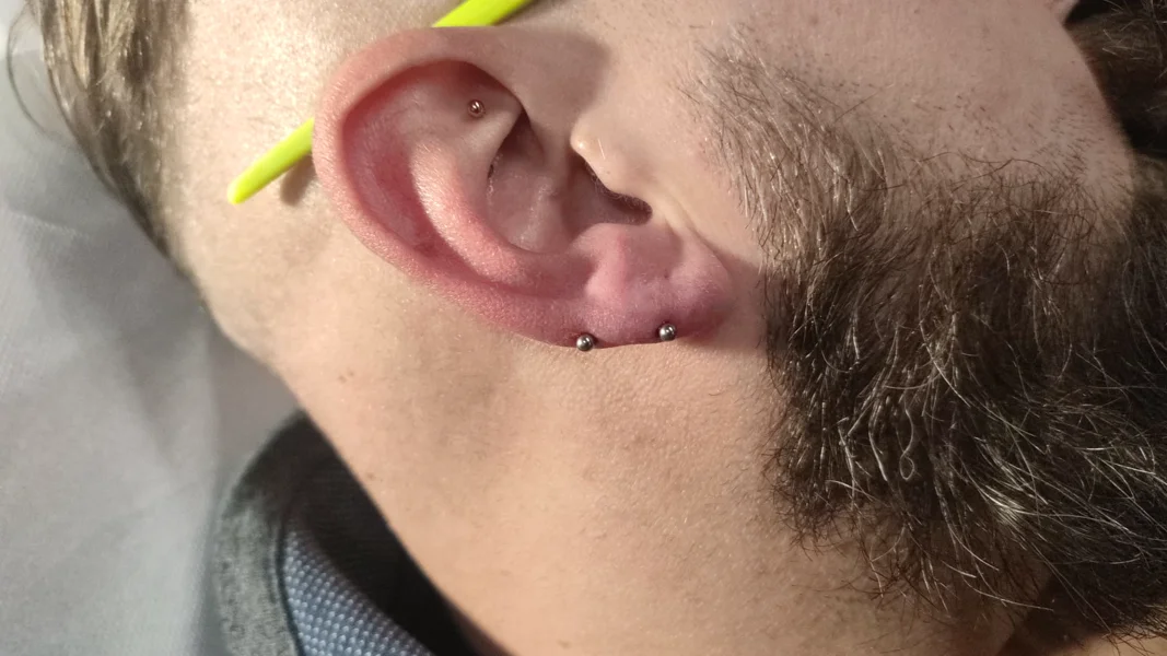 transversal lobe