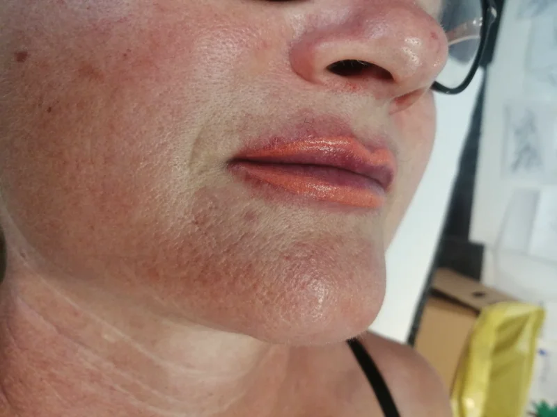 lip dopo