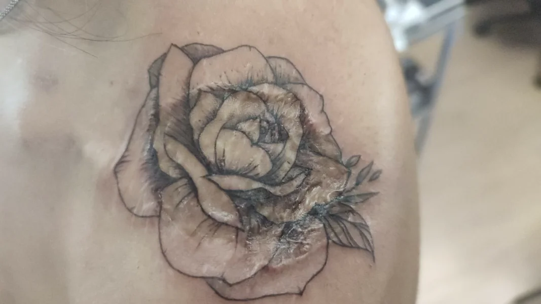 cicatrice-rose-spalla